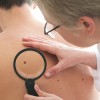 Video May Improve Skin Cancer Diagnosis in Men Dermatologist examines a mole